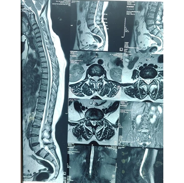 Spine rehabilitation care