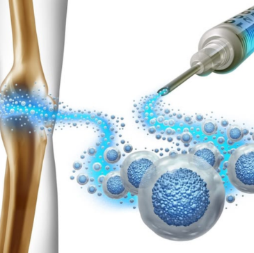 Stem cell regenerative joint support