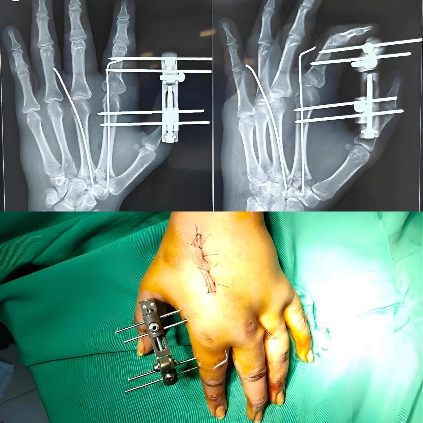Hand Surgery